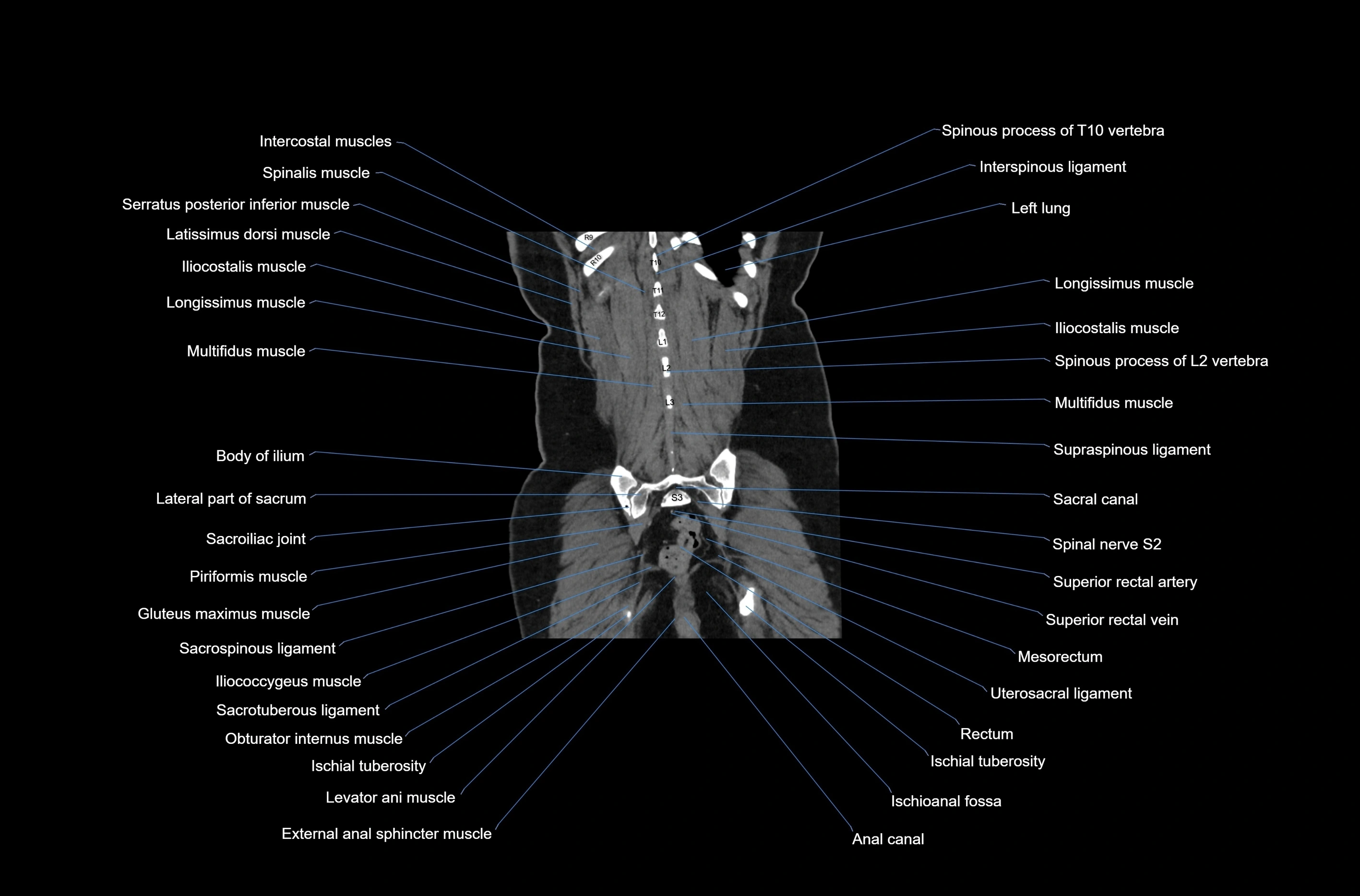 CT abdomen coronal cross sectional anatomy labelled radiology image-00073.webp